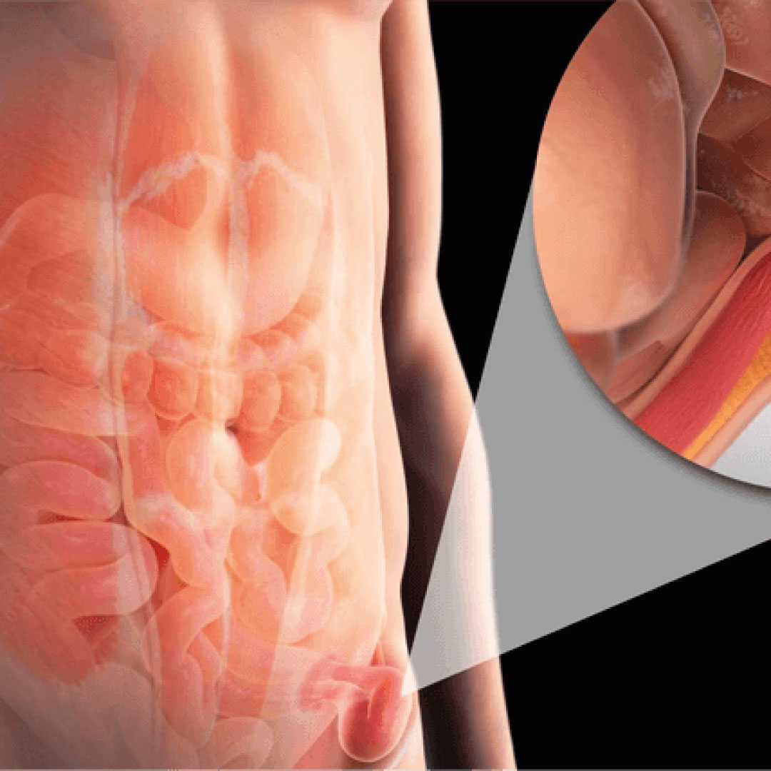 ¿Tienes una hernia abdominal? Aprende a identificarla
